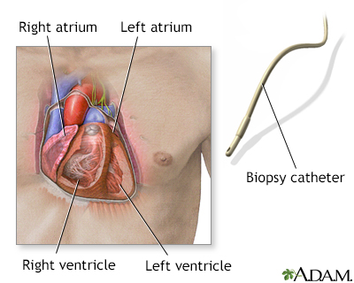 Biopsy catheter - Illustration Thumbnail
              