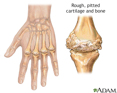 Rheumatoid arthritis - Illustration Thumbnail              