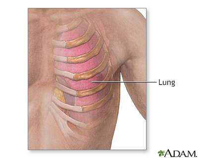 Costochondritis Information