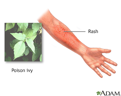 Common Skin Rashes in Adults