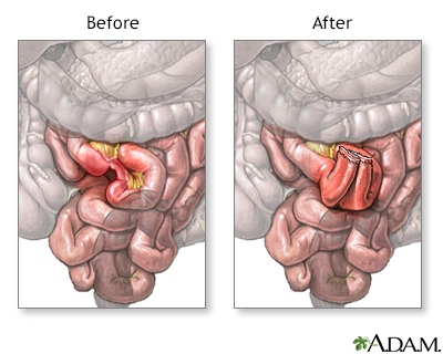 Intestinal obstruction repair Information Mount Sinai New York