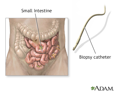 Small intestine biopsy - Illustration Thumbnail              