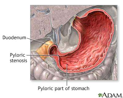 Pyloric stenosis - Illustration Thumbnail
              