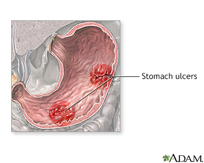 Peptic ulcers often develop due to bacteria infection