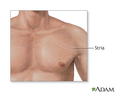 A 27-year-old man with stretch marks, before (left ) and aft er