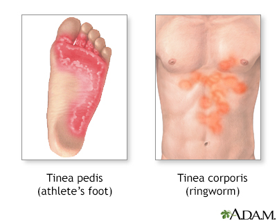 A: Tinea pedis in toe web; B: Tinea capitis showing scaring