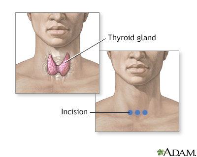 Incision for thyroid gland surgery