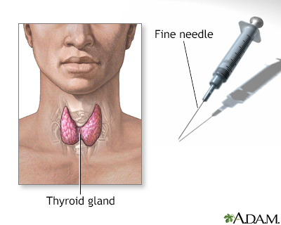 Fine needle on sale aspiration test