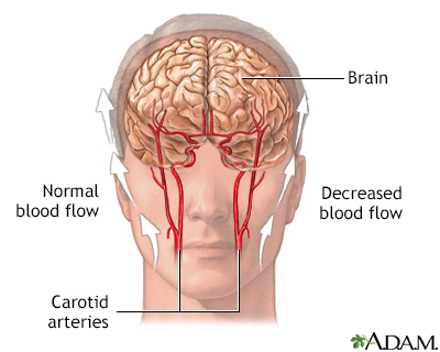 Transient Ischemic attack (TIA) - Illustration Thumbnail
                      