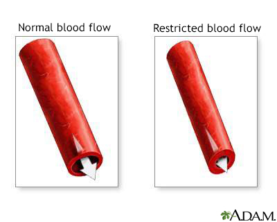 Vasoconstriction - Illustration Thumbnail
              