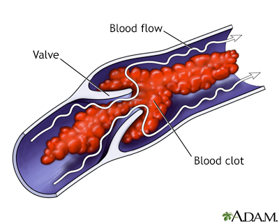 Venous blood clot - Illustration Thumbnail              