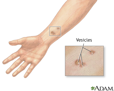 Vesicles Information  Mount Sinai - New York