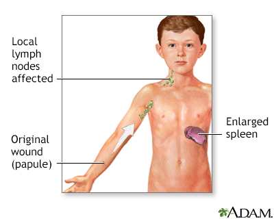 Cat scratch disease - Illustration Thumbnail
                      