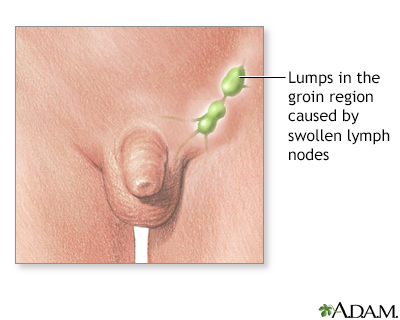 Swollen lymph nodes in the groin - Illustration Thumbnail              