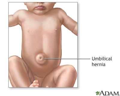 Umbilical hernia - Illustration Thumbnail
              