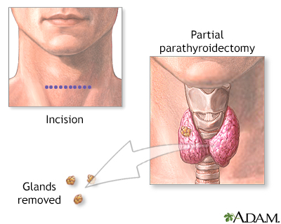 Parathyroidectomy - Illustration Thumbnail
              