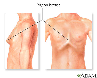 Bowed chest (pigeon breast)