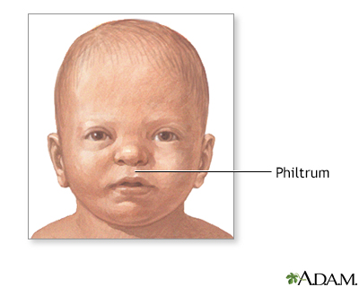 smooth philtrum