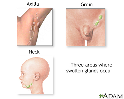 Lymph remedies nodes swollen for Swollen lymph