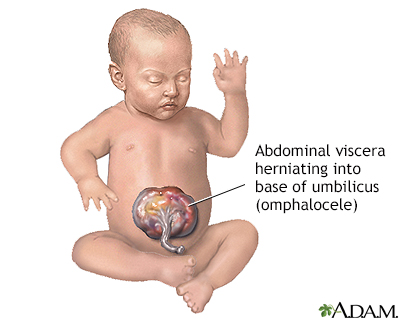 Infant omphalocele - Illustration Thumbnail
              
