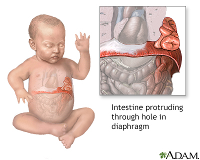 Infant diaphragmatic hernia - Illustration Thumbnail              