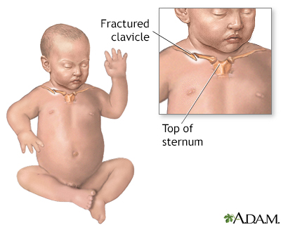 Fractured clavicle (infant)
