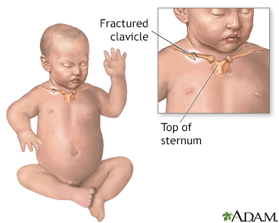 Fractured clavicle (infant) - Illustration Thumbnail
              