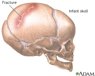 Infant skull fracture