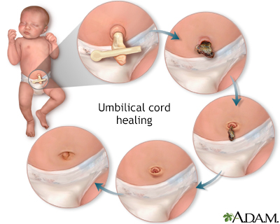 Umbilical cord healing - Illustration Thumbnail              