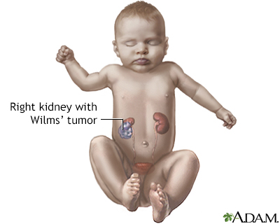 Wilms tumor - Illustration Thumbnail
                      