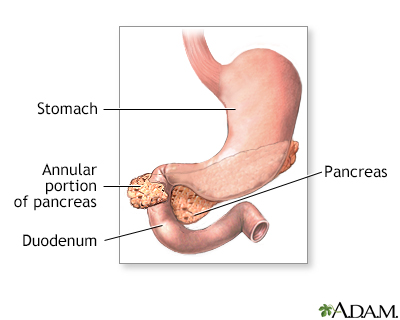 Annular pancreas