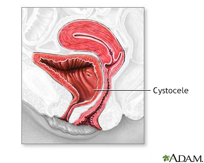 Cystocele - Illustration Thumbnail
                      