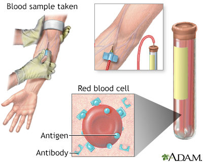 Antibody titer blood test