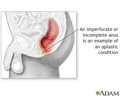 Aplastic condition - Illustration Thumbnail
              