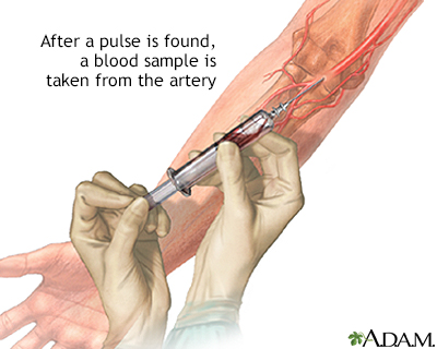 Arterial blood sample - Illustration Thumbnail
              