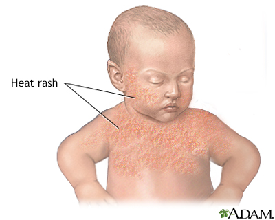 Infant heat rash - Illustration Thumbnail
                      