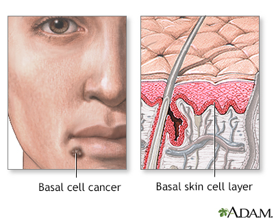 Cancer basocellulaire