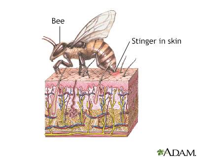 bee sting swelling after 24 hours