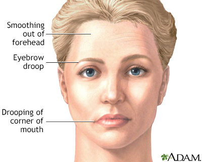 Stroke face droop and paralysis: What stroke looks like