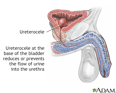 Ureterocele - Illustration Thumbnail
              