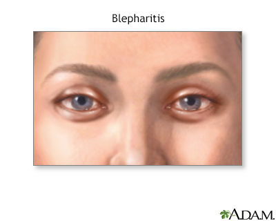 Blepharitis - Illustration Thumbnail
                      