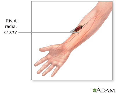 arterial blood gas