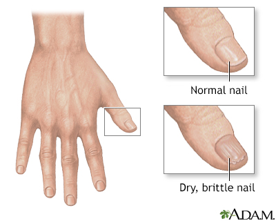 Brittle nails