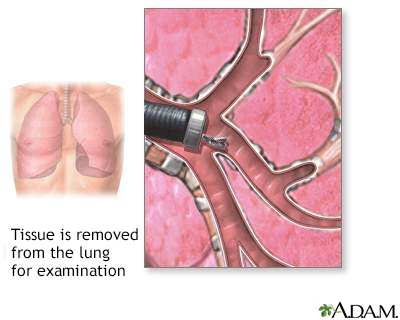 Bronchoscopic culture - Illustration Thumbnail
                      