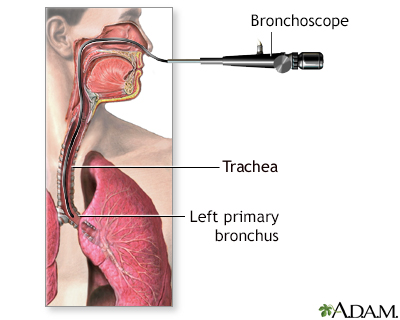 normal bronchoscopy