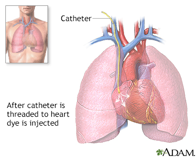 Cardiac catheterization - Illustration Thumbnail
                      