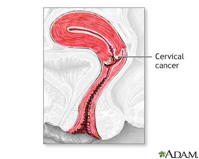 Aga Khan University Hospital, Nairobi - Signs of cervical cancer include  Irregular or postmenopausal bleeding and Increased vaginal discharge.  Cervical cancer can be cured if diagnosed at an early stage and treated