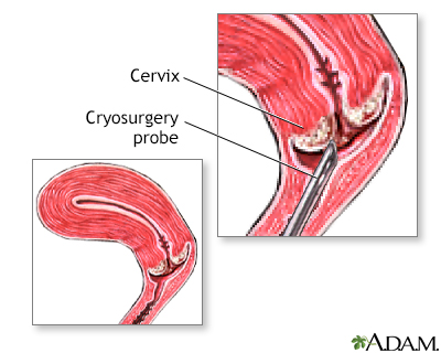 Cervical cryosurgery - Illustration Thumbnail
                      