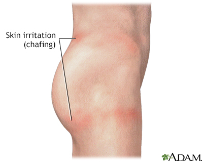 Thigh Chafing: What It Looks Like, Causes, Treatment, Prevention