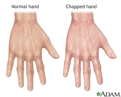 Chapped hands